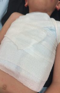 ילד בן 7.5 מטופל בבית החולים הדסה לאחר שנפגע מפירוטכניקה במהלך משחק כדורגל בטדי בירושלים.