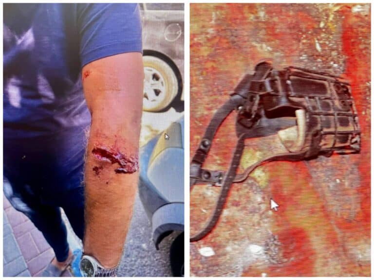 Injured man shows dog bite wounds; muzzle of attack dog left at the scene in a Jerusalem-area assault
