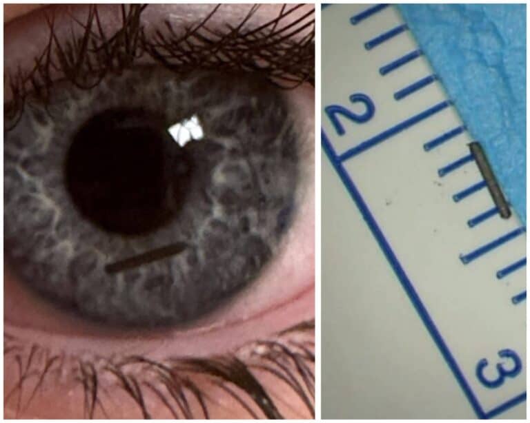 কর্নিয়া আঘাতের পর শিশুর চোখ থেকে অপসারণ করা পেন্সিলের মাথা, যা জেরুজালেমের শারে জেডেকে জরুরি অস্ত্রোপচারে চিকিৎসা করা হয়েছে