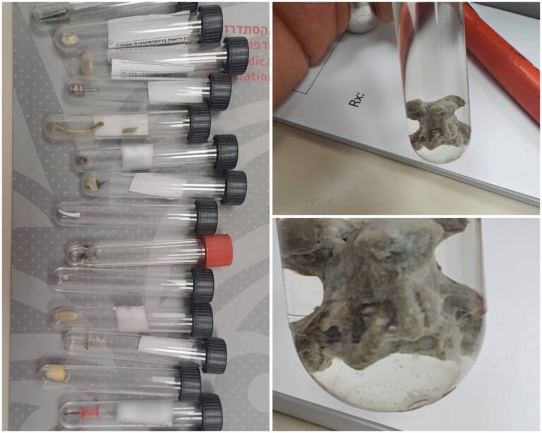 শারে জেদেকে রোগীর ফুসফুস থেকে অপসারণ করা বড় হাড় যা গুরুতর নিউমোনিয়া সৃষ্টি করেছিল