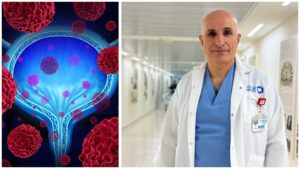 פרופ' בוריס צ'רטין לצד המחשה של סרטן שלפוחית השתן